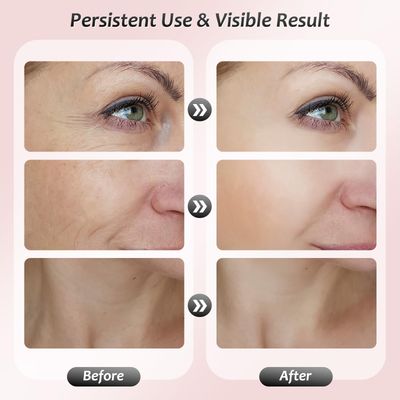 Anti Wrinkle Beauty Apparatus